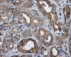 HDAC10 Antibody - IHC of paraffin-embedded Carcinoma of prostate tissue using anti-HDAC10 mouse monoclonal antibody. (Dilution 1:50).