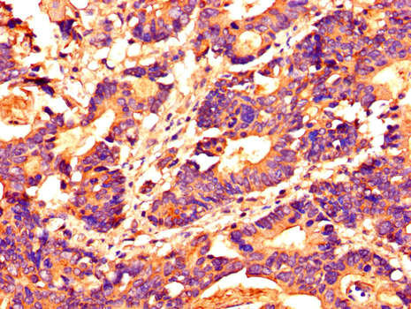HDAC10 Antibody - Immunohistochemistry of paraffin-embedded human colon cancer using HDAC10 Antibody  at dilution of 1:100