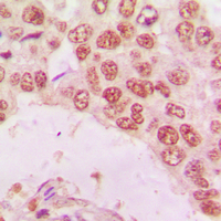HDAC10 Antibody - Immunohistochemical analysis of Histone Deacetylase 10 staining in human lung cancer formalin fixed paraffin embedded tissue section. The section was pre-treated using heat mediated antigen retrieval with sodium citrate buffer (pH 6.0). The section was then incubated with the antibody at room temperature and detected using an HRP conjugated compact polymer system. DAB was used as the chromogen. The section was then counterstained with hematoxylin and mounted with DPX.