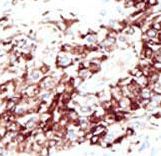 HDAC11 Antibody - Formalin-fixed and paraffin-embedded human cancer tissue reacted with the primary antibody, which was peroxidase-conjugated to the secondary antibody, followed by DAB staining. This data demonstrates the use of this antibody for immunohistochemistry; clinical relevance has not been evaluated. BC = breast carcinoma; HC = hepatocarcinoma.