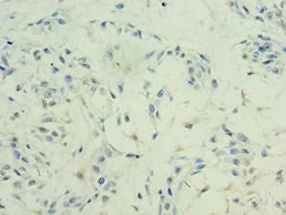 HDAC11 Antibody - Immunohistochemistry of paraffin-embedded human breast cancer using antibody at 1:100 dilution.