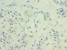 HDAC11 Antibody - Immunohistochemistry of paraffin-embedded human breast cancer using antibody at 1:100 dilution.
