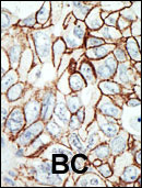 HDAC11 Antibody - Purified rabbit anti-HDAC11 antibody was used in immunohistochemistry on Breast Carcinoma.