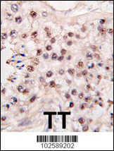 HDAC11 Antibody - Formalin-fixed and paraffin-embedded human testicle tumor tissue reacted with HDAC11 antibody , which was peroxidase-conjugated to the secondary antibody, followed by DAB staining. This data demonstrates the use of this antibody for immunohistochemistry; clinical relevance has not been evaluated.
