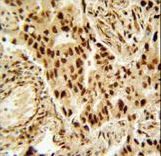 HDAC2 Antibody - HDAC2 Antibody immunohistochemistry of formalin-fixed and paraffin-embedded human lung carcinoma followed by peroxidase-conjugated secondary antibody and DAB staining.