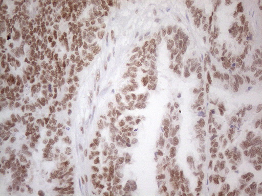 HDAC2 Antibody - Immunohistochemical staining of paraffin-embedded Adenocarcinoma of Human ovary tissue using anti-HDAC2 mouse monoclonal antibody. (Heat-induced epitope retrieval by 1mM EDTA in 10mM Tris buffer. (pH8.5) at 120°C for 3 min. (1:150)