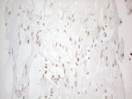 HDAC2 Antibody - Immunohistochemical staining of paraffin-embedded Carcinoma of Human pancreas tissue using anti-HDAC2 mouse monoclonal antibody. (Heat-induced epitope retrieval by 1mM EDTA in 10mM Tris buffer. (pH8.5) at 120°C for 3 min. (1:150)