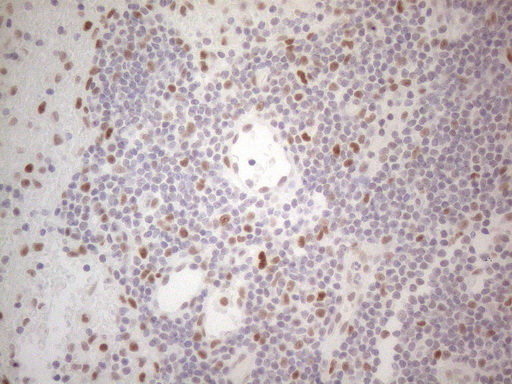 HDAC2 Antibody - Immunohistochemical staining of paraffin-embedded Carcinoma of Human thyroid tissue using anti-HDAC2 mouse monoclonal antibody. (Heat-induced epitope retrieval by 1mM EDTA in 10mM Tris buffer. (pH8.5) at 120°C for 3 min. (1:150)