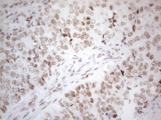 HDAC2 Antibody - Immunohistochemical staining of paraffin-embedded Adenocarcinoma of Human endometrium tissue using anti-HDAC2 mouse monoclonal antibody. (Heat-induced epitope retrieval by 1mM EDTA in 10mM Tris buffer. (pH8.5) at 120°C for 3 min. (1:150)