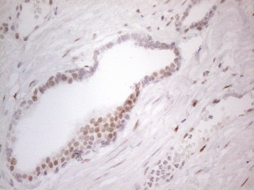 HDAC2 Antibody - Immunohistochemical staining of paraffin-embedded Carcinoma of Human prostate tissue using anti-HDAC2 mouse monoclonal antibody. (Heat-induced epitope retrieval by 1mM EDTA in 10mM Tris buffer. (pH8.5) at 120°C for 3 min. (1:150)