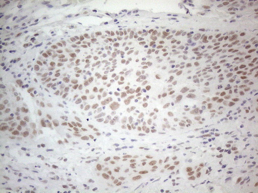 HDAC2 Antibody - Immunohistochemical staining of paraffin-embedded Carcinoma of Human bladder tissue using anti-HDAC2 mouse monoclonal antibody. (Heat-induced epitope retrieval by 1mM EDTA in 10mM Tris buffer. (pH8.5) at 120°C for 3 min. (1:150)