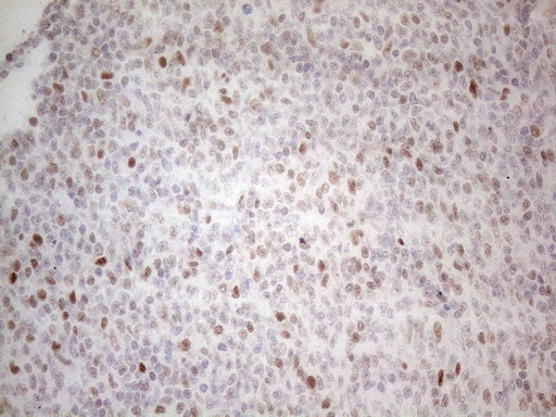 HDAC2 Antibody - Immunohistochemical staining of paraffin-embedded Human lymphoma tissue using anti-HDAC2 mouse monoclonal antibody. (Heat-induced epitope retrieval by 1mM EDTA in 10mM Tris buffer. (pH8.5) at 120°C for 3 min. (1:150)