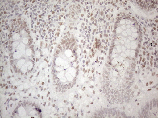HDAC2 Antibody - Immunohistochemical staining of paraffin-embedded Human colon tissue within the normal limits using anti-HDAC2 mouse monoclonal antibody. (Heat-induced epitope retrieval by 1mM EDTA in 10mM Tris buffer. (pH8.5) at 120°C for 3 min. (1:150)