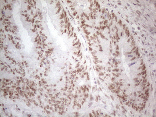 HDAC2 Antibody - Immunohistochemical staining of paraffin-embedded Adenocarcinoma of Human colon tissue using anti-HDAC2 mouse monoclonal antibody. (Heat-induced epitope retrieval by 1mM EDTA in 10mM Tris buffer. (pH8.5) at 120°C for 3 min. (1:150)