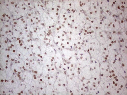 HDAC2 Antibody - Immunohistochemical staining of paraffin-embedded Carcinoma of Human kidney tissue using anti-HDAC2 mouse monoclonal antibody. (Heat-induced epitope retrieval by 1mM EDTA in 10mM Tris buffer. (pH8.5) at 120°C for 3 min. (1:150)