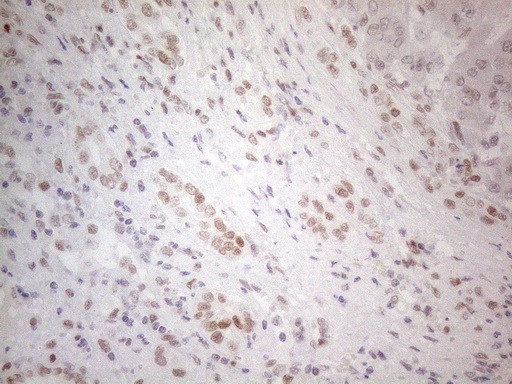 HDAC2 Antibody - Immunohistochemical staining of paraffin-embedded Carcinoma of Human liver tissue using anti-HDAC2 mouse monoclonal antibody. (Heat-induced epitope retrieval by 1mM EDTA in 10mM Tris buffer. (pH8.5) at 120°C for 3 min. (1:150)