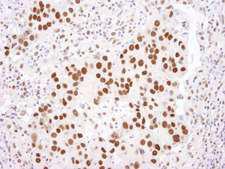 HDAC2 Antibody - Detection of Human HDAC2 by Immunohistochemistry. Sample: FFPE section of human breast adenocarcinoma. Antibody: Affinity purified rabbit anti-HDAC2 used at a dilution of 1:250. Detection: DAB.