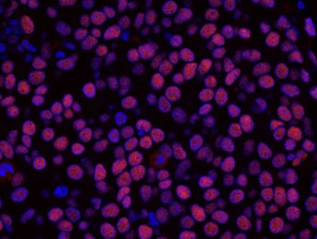 HDAC2 Antibody - Detection of human HDAC2 by immunohistochemistry. Sample: FFPE section of human breast carcinoma. Antibody: Affinity purified rabbit anti-HDAC2 used at a dilution of 1:100. Detection: Red-fluorescent Alexa Fluor® 555 goat anti-rabbit IgG (Invitrogen) used at a dilution of 1:500.