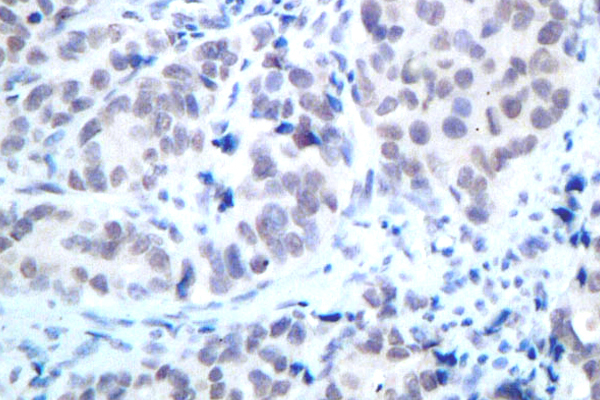 HDAC2 Antibody - IHC of HDAC2 (D388) pAb in paraffin-embedded human breast carcinoma tissue.