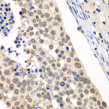 HDAC2 Antibody - Immunohistochemistry of paraffin-embedded human lung cancer tissue.