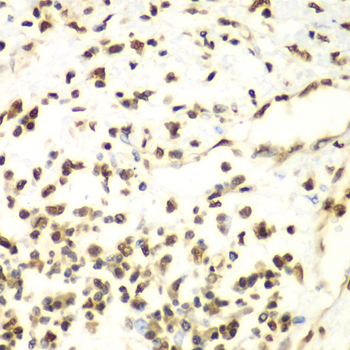 HDAC2 Antibody - Immunohistochemistry of paraffin-embedded human liver cancer tissue.
