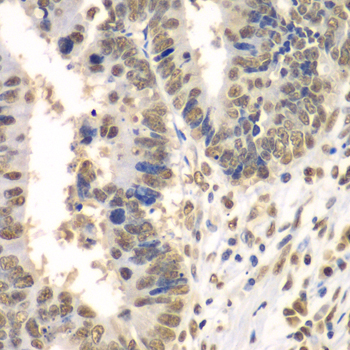 HDAC2 Antibody - Immunohistochemistry of paraffin-embedded human colon carcinoma tissue.