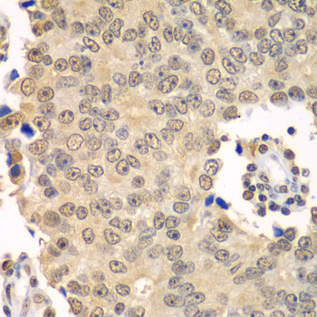 HDAC2 Antibody - Immunohistochemistry of paraffin-embedded human prostate cancer tissue.