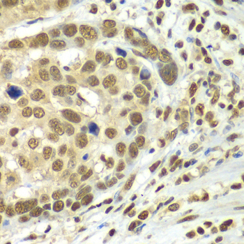 HDAC2 Antibody - Immunohistochemistry of paraffin-embedded human esophageal cancer tissue.