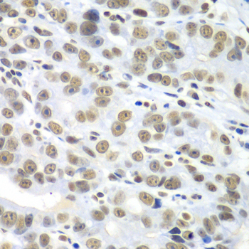 HDAC2 Antibody - Immunohistochemistry of paraffin-embedded human gastric cancer tissue.