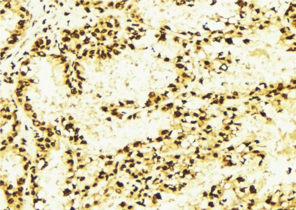 HDAC2 Antibody - 1:100 staining human lung tissue by IHC-P. The sample was formaldehyde fixed and a heat mediated antigen retrieval step in citrate buffer was performed. The sample was then blocked and incubated with the antibody for 1.5 hours at 22°C. An HRP conjugated goat anti-rabbit antibody was used as the secondary.