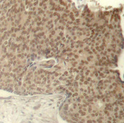 HDAC2 Antibody - Immunohistochemical analysis of paraffin-embedded human breast carcinoma tissue.