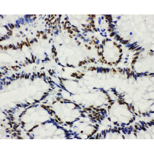 HDAC3 Antibody - HDAC3 antibody. IHC(P): Human Intestinal Cancer Tissue.
