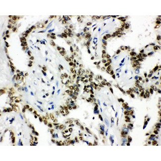 HDAC3 Antibody - HDAC3 antibody. IHC(P): Human Lung Cancer Tissue.