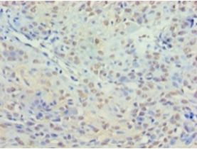 HDAC3 Antibody - Immunohistochemistry of paraffin-embedded human breast cancer using antibody at 1:100 dilution.  This image was taken for the unconjugated form of this product. Other forms have not been tested.