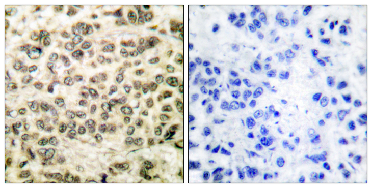 HDAC3 Antibody - Immunohistochemistry analysis of paraffin-embedded human breast carcinoma tissue, using HDAC3 Antibody. The picture on the right is blocked with the synthesized peptide.