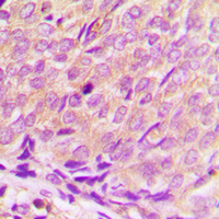 HDAC3 Antibody - Immunohistochemical analysis of Histone Deacetylase 3 staining in human breast cancer formalin fixed paraffin embedded tissue section. The section was pre-treated using heat mediated antigen retrieval with sodium citrate buffer (pH 6.0). The section was then incubated with the antibody at room temperature and detected using an HRP conjugated compact polymer system. DAB was used as the chromogen. The section was then counterstained with hematoxylin and mounted with DPX.