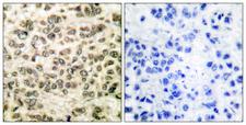 HDAC3 Antibody - Peptide - + Immunohistochemical analysis of paraffin-embedded human breast carcinoma tissue using HDAC3 antibody