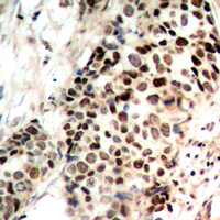 HDAC3 Antibody - Immunohistochemical analysis of Histone Deacetylase 3 (pS424) staining in human breast cancer formalin fixed paraffin embedded tissue section. The section was pre-treated using heat mediated antigen retrieval with sodium citrate buffer (pH 6.0). The section was then incubated with the antibody at room temperature and detected using an HRP conjugated compact polymer system. DAB was used as the chromogen. The section was then counterstained with hematoxylin and mounted with DPX.