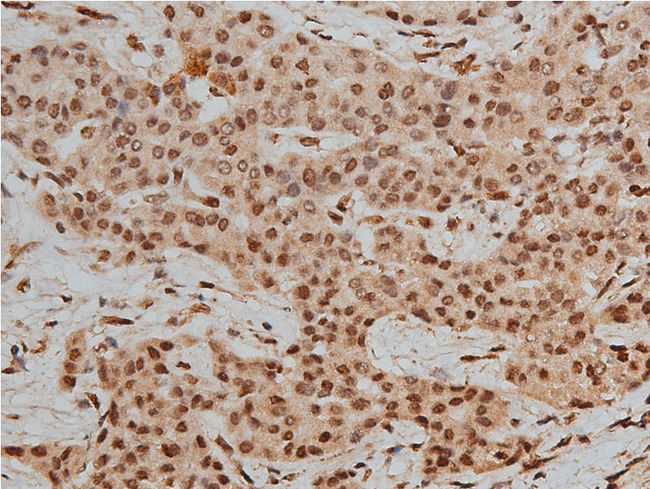HDAC3 Antibody - 1:50 staining human liver carcinoma tissues by IHC-P. The tissue was formaldehyde fixed and a heat mediated antigen retrieval step in citrate buffer was performed. The tissue was then blocked and incubated with the antibody for 1.5 hours at 22°C. An HRP conjugated goat anti-rabbit antibody was used as the secondary.