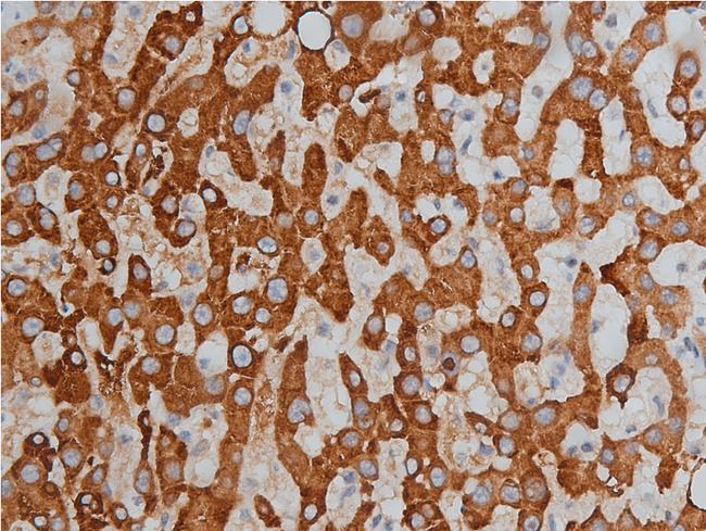 HDAC3 Antibody - 1:200 staining human liver carcinoma tissues by IHC-P. The tissue was formaldehyde fixed and a heat mediated antigen retrieval step in citrate buffer was performed. The tissue was then blocked and incubated with the antibody for 1.5 hours at 22°C. An HRP conjugated goat anti-rabbit antibody was used as the secondary.
