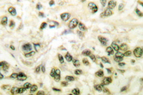 HDAC3 Antibody - IHC of SMAP45 (Y414) pAb in paraffin-embedded human breast carcinoma tissue.