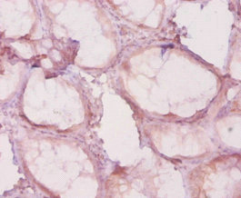 HDAC4 Antibody - Immunohistochemistry of paraffin-embedded human colon cancer using HDAC4 Antibody at dilution of 1:20