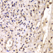HDAC4 Antibody - Immunohistochemistry of paraffin-embedded human mammary cancer tissue.
