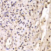 HDAC4 Antibody - Immunohistochemistry of paraffin-embedded Human breast cancer using HDAC4 Polyclonal Antibody at dilution of 1:100 (40x lens).
