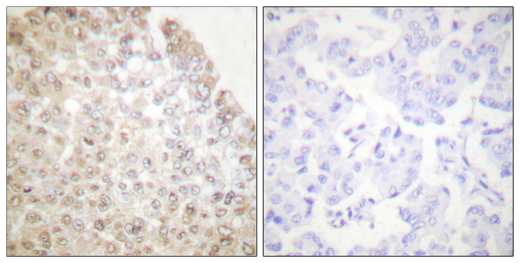 HDAC5 Antibody - Immunohistochemistry analysis of paraffin-embedded human breast carcinoma tissue, using HDAC5 Antibody. The picture on the right is blocked with the synthesized peptide.