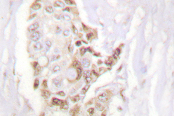 HDAC5 Antibody - IHC of HDAC5 (E1106) pAb in paraffin-embedded human breast carcinoma tissue.