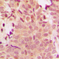 HDAC5 Antibody - Immunohistochemical analysis of Histone Deacetylase 5 staining in human breast cancer formalin fixed paraffin embedded tissue section. The section was pre-treated using heat mediated antigen retrieval with sodium citrate buffer (pH 6.0). The section was then incubated with the antibody at room temperature and detected using an HRP conjugated compact polymer system. DAB was used as the chromogen. The section was then counterstained with hematoxylin and mounted with DPX.
