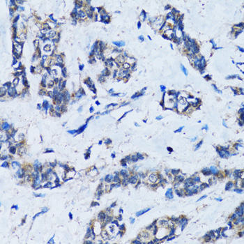 HDAC5 Antibody - Immunohistochemistry of paraffin-embedded human breast cancer using HDAC5 antibody at dilution of 1:100 (40x lens).