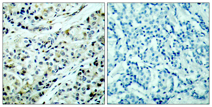 HDAC5 Antibody - Immunohistochemistry analysis of paraffin-embedded human breast carcinoma, using HDAC5 (Phospho-Ser498) Antibody. The picture on the right is blocked with the phospho peptide.