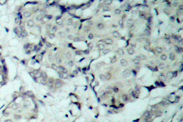 HDAC5 Antibody - IHC of p-HDAC5 (S498) pAb in paraffin-embedded human breast carcinoma tissue.